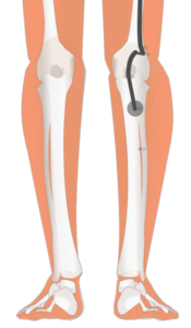 07 BL56 Chengjin Supporting Ligaments 承筋